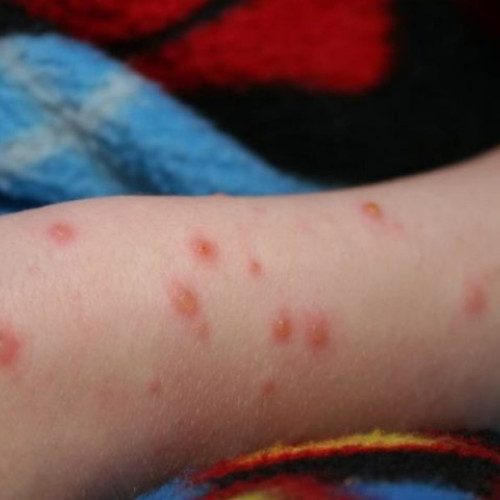 850 noi cazuri de rujeolă și alte 2 decese raportate de autoritățile sanitare în ultima săptămână. Bilanțul total de la începutul anului ajunge la aproape 9.700 de cazuri, dintre care 11 fatale.