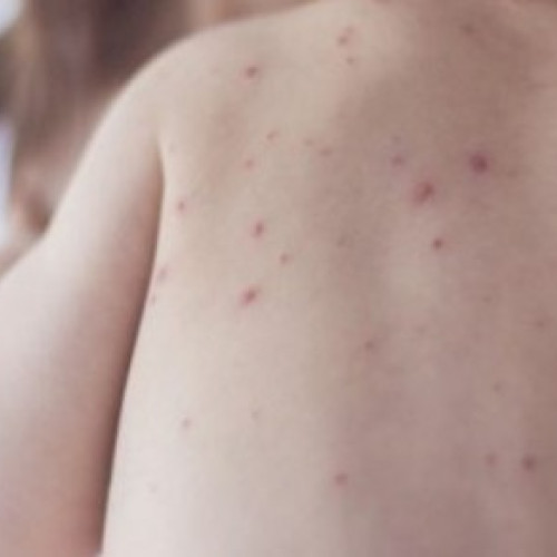 Creşterea cazurilor de rujeolă: Aproape 950 de noi îmbolnăviri înregistrate săptămâna trecută în România